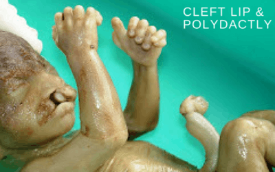 Cleft Lip & Polydactyly