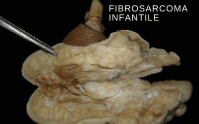 Infantile Fibrosarcoma