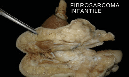 Infantile Fibrosarcoma